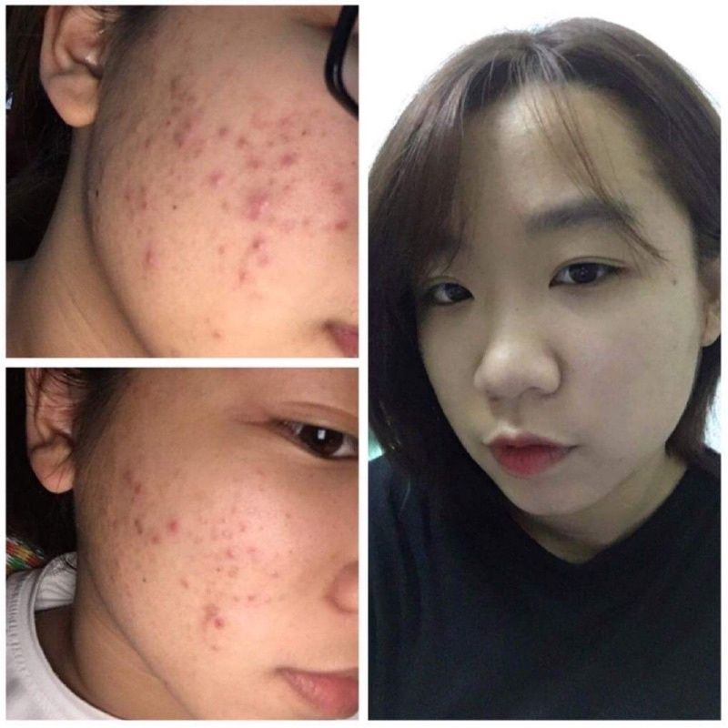 Serum mụn Nhà Bơ