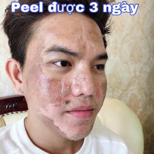 Peel da TCA thay da sinh học mụn, rỗ, thâm, nám, lỗ chân lông to, da dầu, rạn, sẹo lồi, làm trắng mịn da