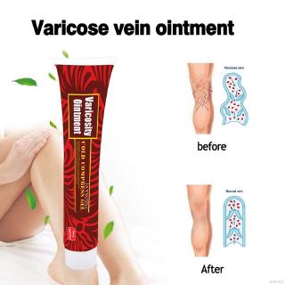 [Hàng mới về] Tuýp thuốc mỡ trong suốt dành cho người bị giãn tĩnh mạch vận động viên