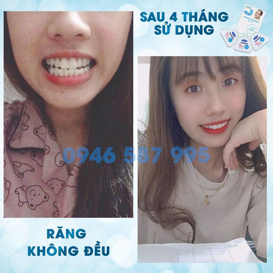 Dụng Cụ Niềng Răng Tại Nhà TRAINER