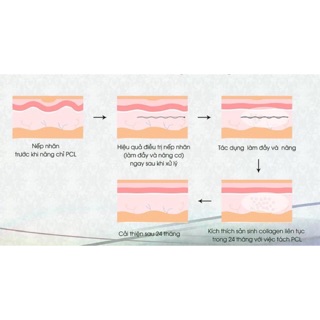 CHỈ CĂNG DA MẶT