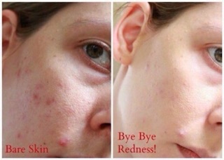 Chấm mụn bye bye blemish