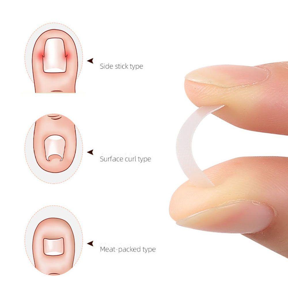 BORAG Bộ 10 Miếng Dán Chỉnh Hình Móng Chân Mọc Ngược DIY