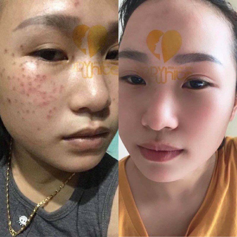 Chấm Tàn Nhang Mụn Nám Rỗ Phương Anh | BigBuy360 - bigbuy360.vn