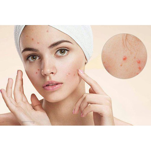 🔰 🔰 VIÊN UỐNG CHO DA MỤN MURIKO - GIẢI PHÁP "TIÊU DIỆT" MỤN TẬN GỐC TỪ BÊN TRONG. | BigBuy360 - bigbuy360.vn