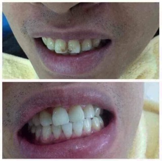 Bột than hoạt tính làm trắng răng