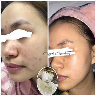 SERUM BHA TRI MỤN