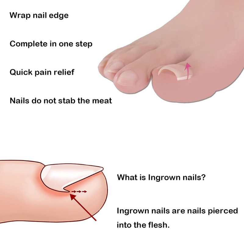 Dụng Cụ Định Hình Móng Chân Mọc Ngược Bằng Thép Không Gỉ Chuyên Nghiệp YOUYO