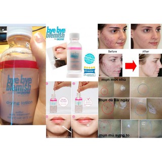 Chấm mụn Bye Bye Blemish Drying Lotion