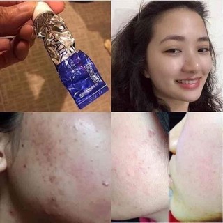 Kem trị mụn Pair Nhật Bản