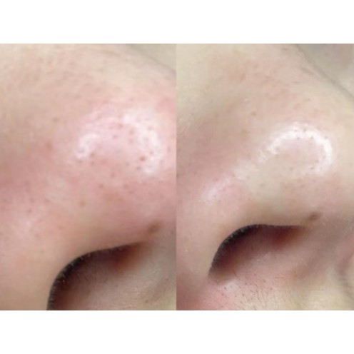 Serum ủ mụn, gel lột mụn đầu đen mụn cám kèm kem dưỡng sau lột mụn