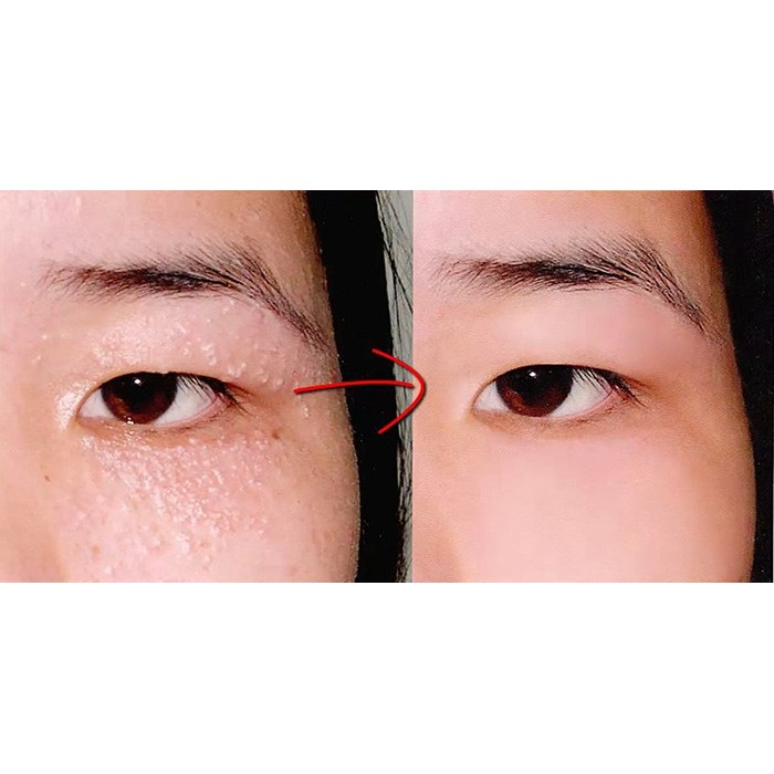 Kem Hỗ Trợ Xóa Mụn Thịt Vùng Mắt Tsubuporon Eye Essence