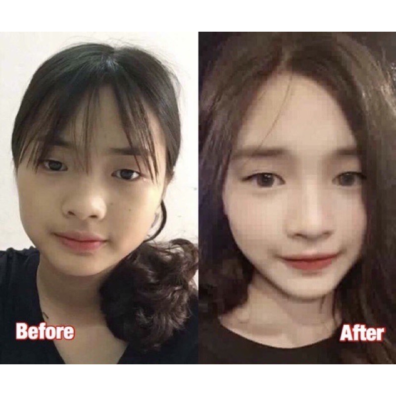 Tinh chất thu xương hàm má Miracle - Pháp, hiệu quả chỉ sau 14 ngày (10ml)