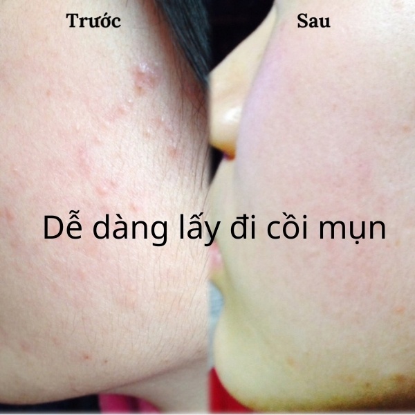 KEM NGĂN NGỪA MỤN, KEM LÀM MỜ SẸO GENTACIN NHẬT BẢN 10G