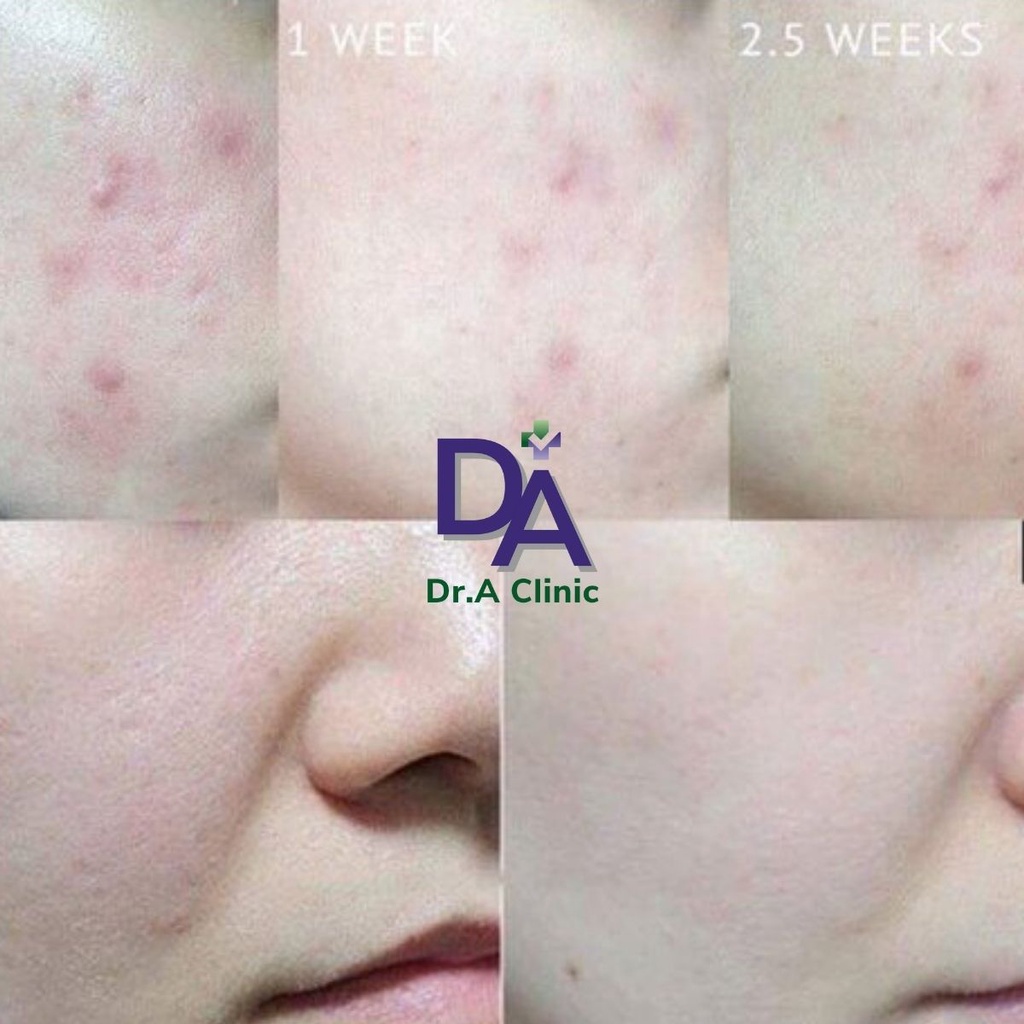 Combo Giảm Mụn Dr.A Clinic dành cho mụn ẩn, mụn đầu đen, mụn trứng cá hiệu quả dài lâu