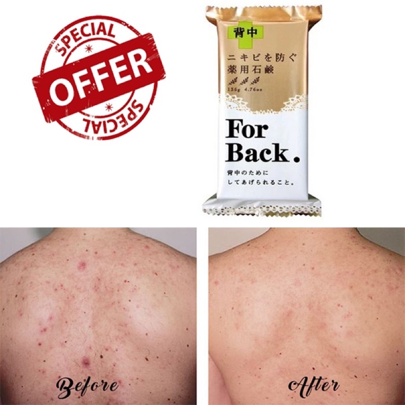 [FREE SHIP] Xà phòng forback giảm mụn lưng chíng hãng