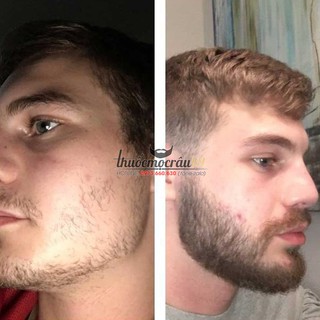 Thuốc mọc râu Minoxidil 5% dạng bọt