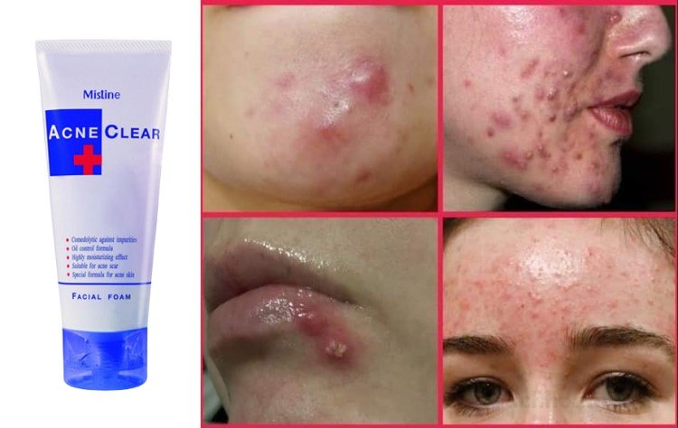 Sữa rửa mặt sạch mụȵ kháng vıêm mờ şẹo Mistine Acne Clear Facial Foam Thái Lan