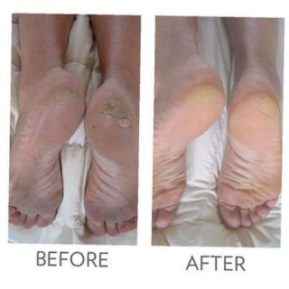 KEM TRỊ NỨT GÓT CHÂN