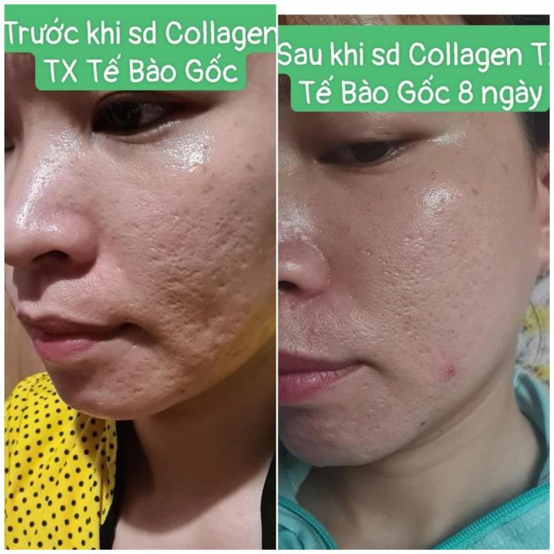 Colagen tế bào gốc tặng mặt nạ đẹp da