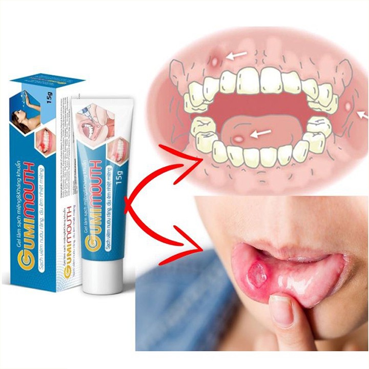 Gel Gumimouth - Sạch viêm nướu răng và dịu êm nhiệt miệng- tuýp 15gram.