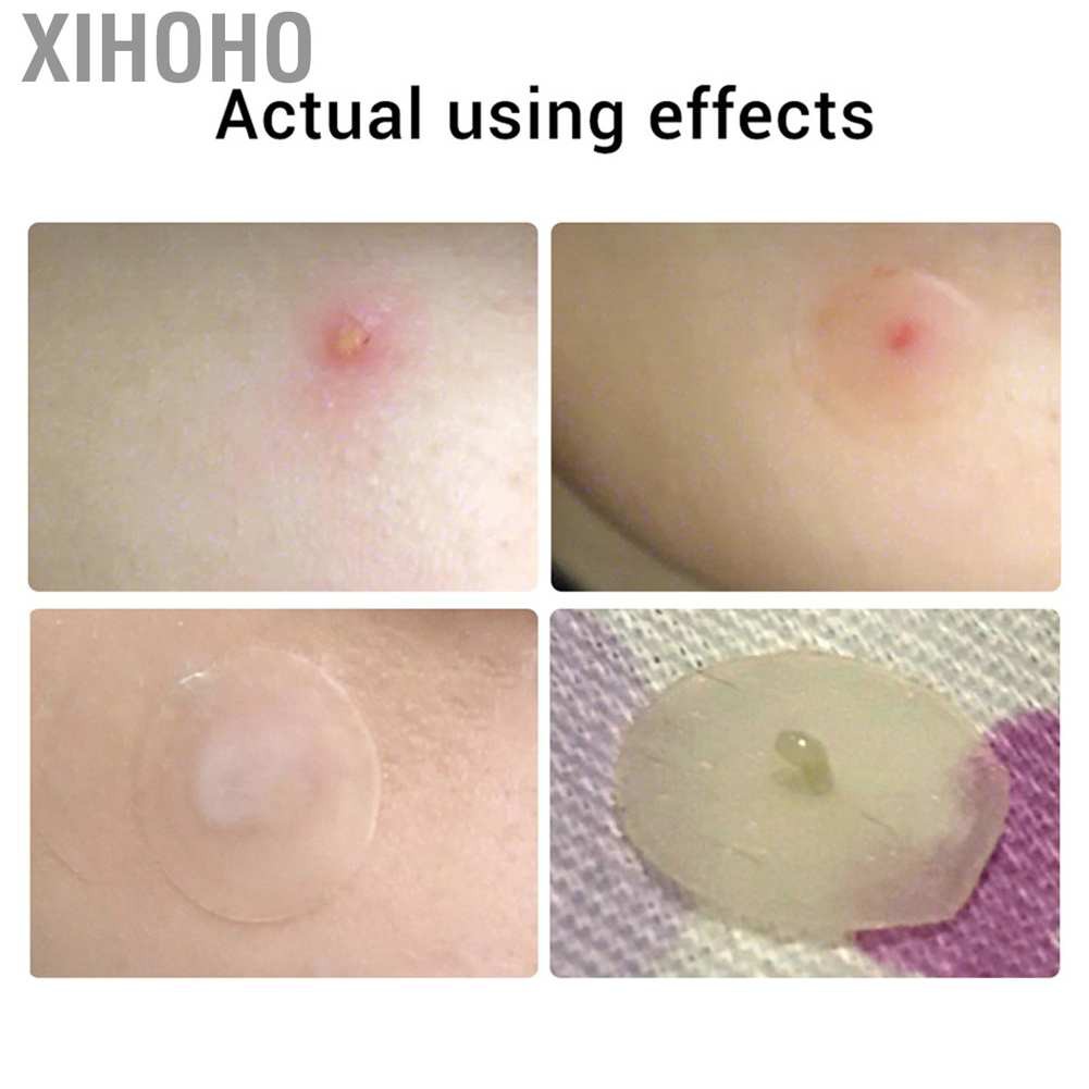 (hàng Mới Về) Miếng Dán Trị Mụn Tinh Chất Tràm Trà | BigBuy360 - bigbuy360.vn