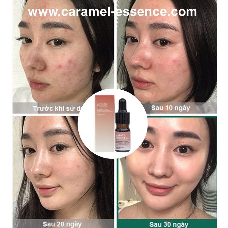 Combo 2Serum tang 1 Caramel Essence  ttrị mụn,kiểm soát bã nhờn, ngừa thâm sẹo Nhật Bản