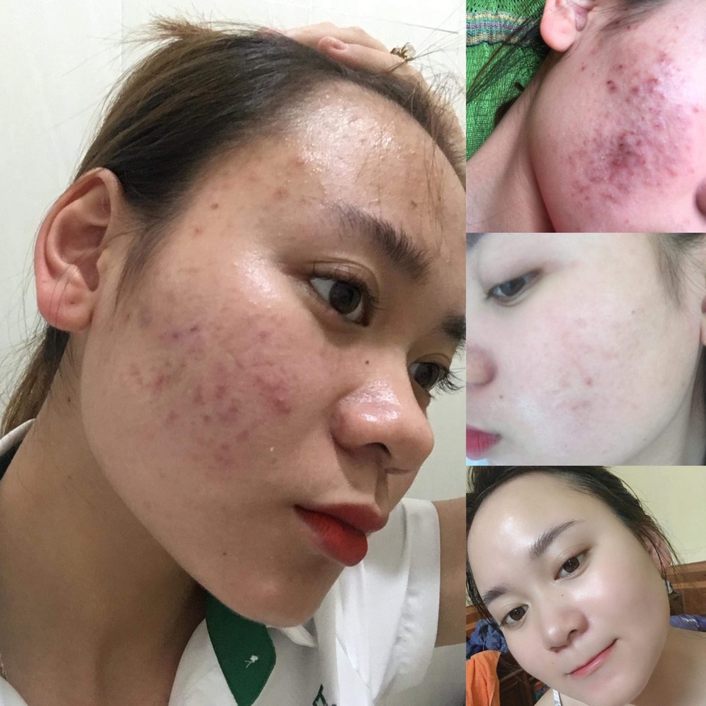 Mỹ Phẩm Ngọc Sâm Ngăn Ngừa Mụn, Nám, Rỗ | BigBuy360 - bigbuy360.vn