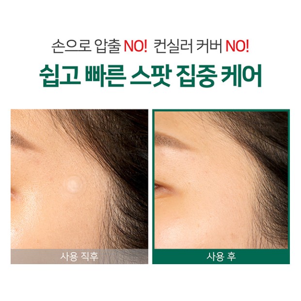 Miếng Dán Mụn &quot;Thần Kỳ' Some By Mi Clear Spot Patch (Set 18 miếng)