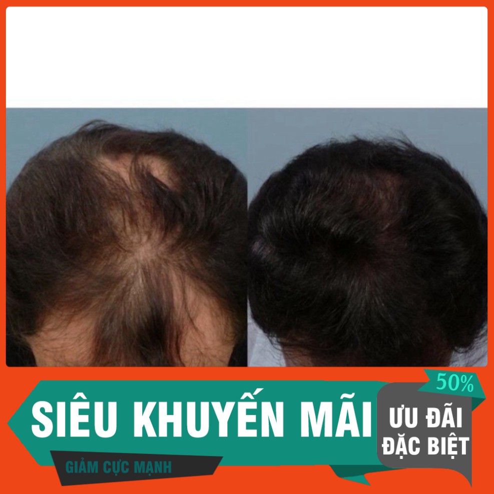 CỦ XẢ CỦ XẢ Viên uống hỗ trợ mọc tóc Biotin 10,000mcg - Dùng kèm Minoxidil CỦ XẢ CỦ XẢ