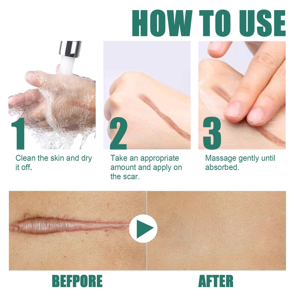 EELHOE kem xóa sẹo, xoá sẹo bỏng,sẹo mụn,sẹo trầy xước.khổi phục da nhanh chóng,xóa rạn da,kem xóa sẹo
