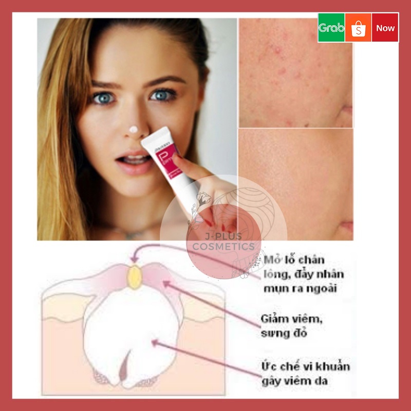 Kem Ngăn Ngừa Mụn Pimplit Acne Remedy 18g [Nhật Bản]