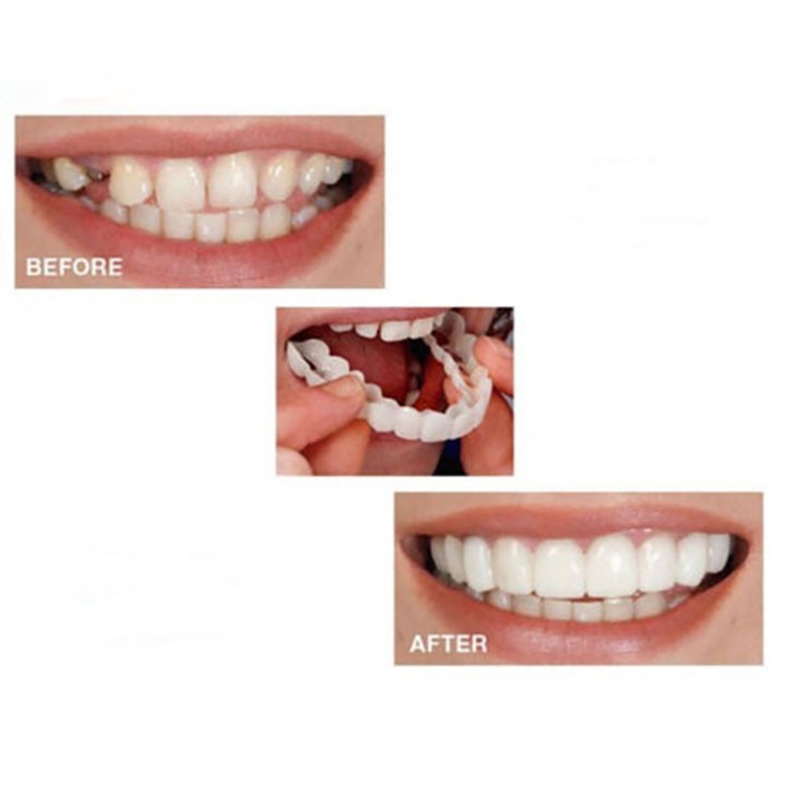 Dụng cụ niềng răng tại nhà snapon smile