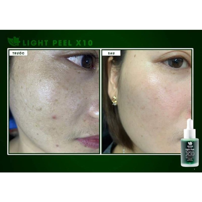 Light Peel X10 Linh Hương Chính Hãng - lăn kim, phi kim tại nhà