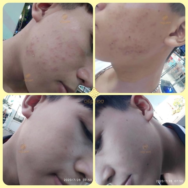 SERUM OGANA trị mụn