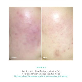 Dòng sản phẩm da mụn Byecom Pure Calming