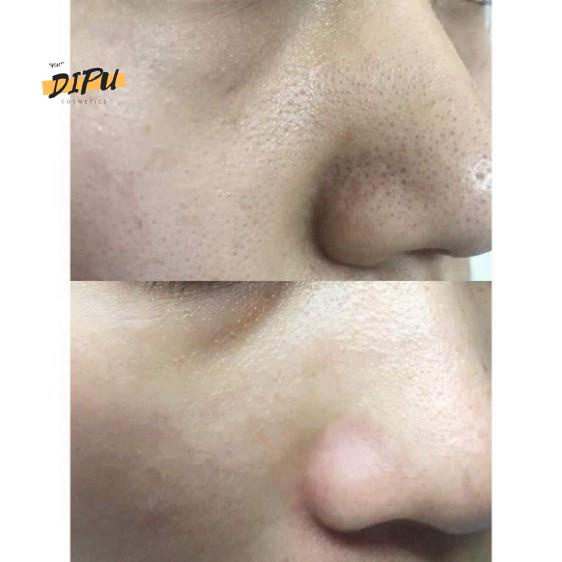 Ủ Mụn Medi-Peel Extra Super9- 50-100ml Mụn Cám Mụn Đầu Đen, Mụn Cám | BigBuy360 - bigbuy360.vn