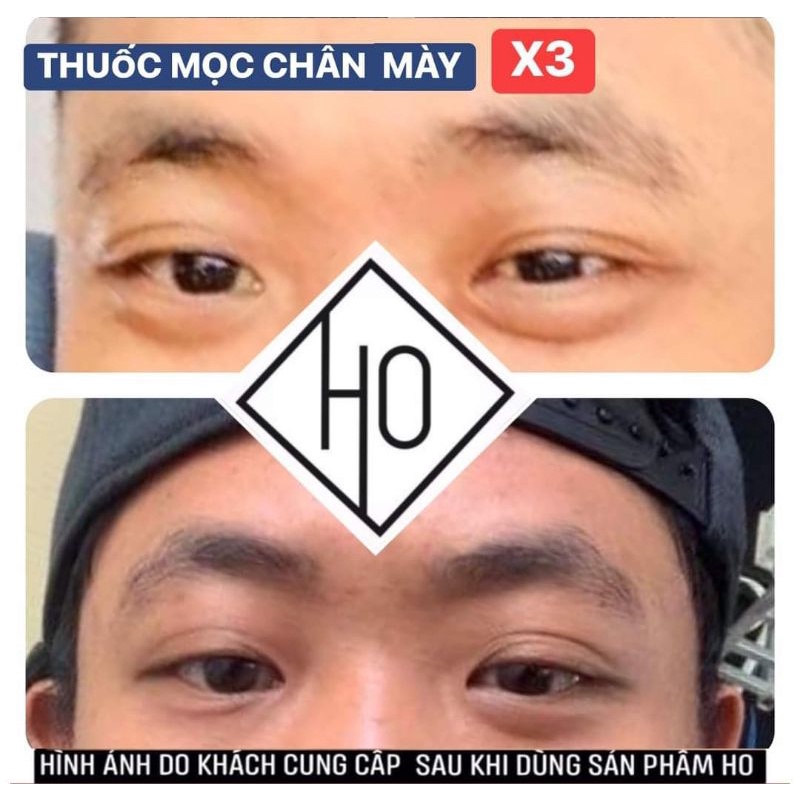 THUỐC MỌC RÂU 😄LÔNG MÀY 😄SIÊU SALE (an toàn, CHÍNH HÃNG)