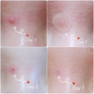 Miếng Dán Trị Mụn Cosrx Acne Pimple Master Patch
