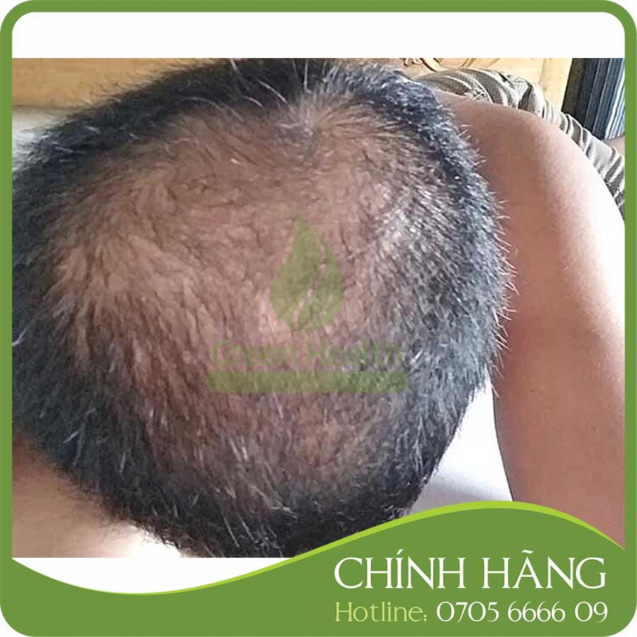 Serum mọc tóc - Minoxidil &amp; Finasteride 10% - Morr F 10% F10 (60ml)