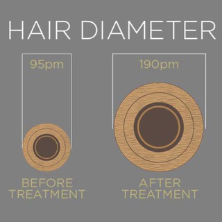 Thuốc mọc tóc Minoxidil 5% cho Nữ