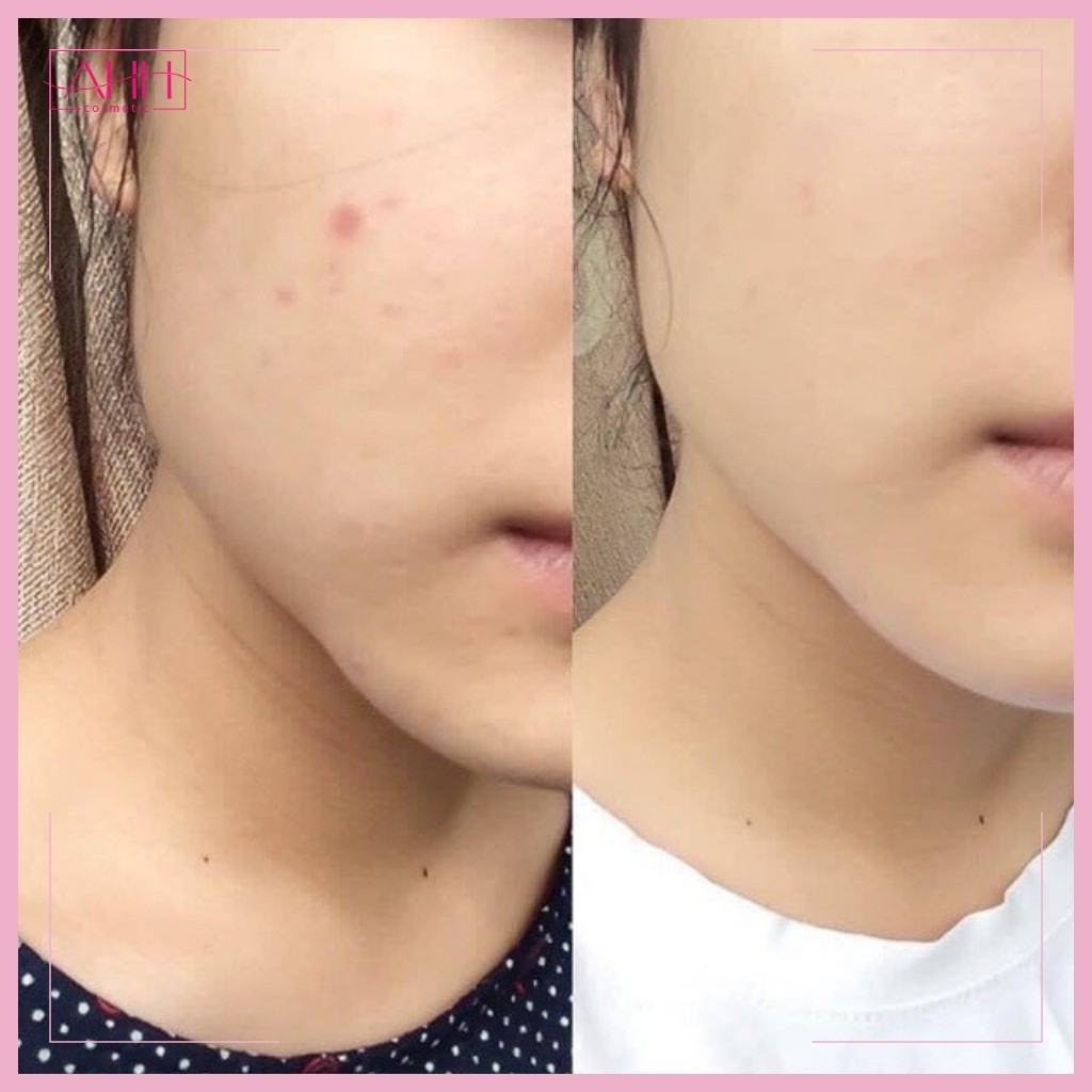 Serum The Ordinary [ HÀNG CHÍNH HÃNG] Niacinamide 10% + Zinc 1% Giảm Viêm , Giảm Mụn AHH Cosmetic | BigBuy360 - bigbuy360.vn