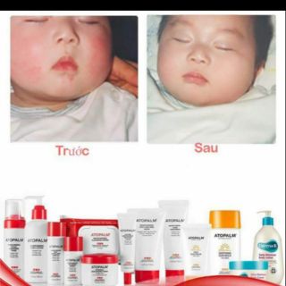 Kem dưỡng ẩm atopalm