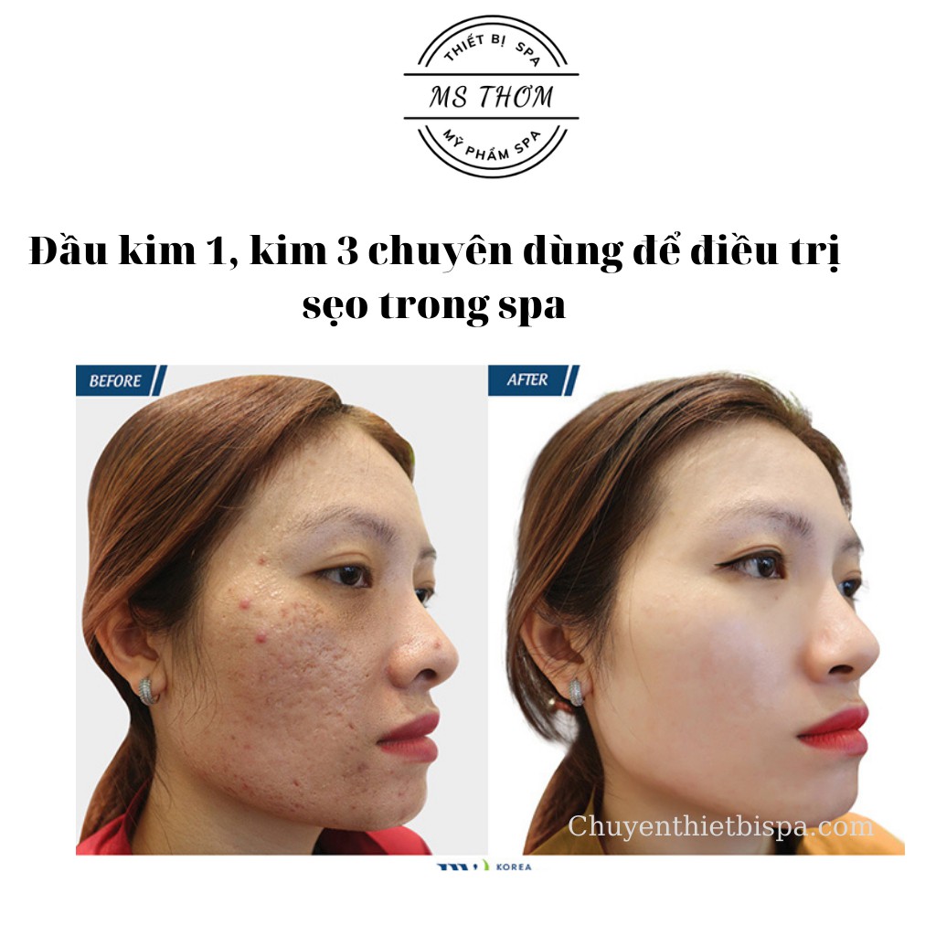 Đầu kim 1 và 3, phá đáy sẹo chuyên dùng trong spa/thẩm mỹ viện