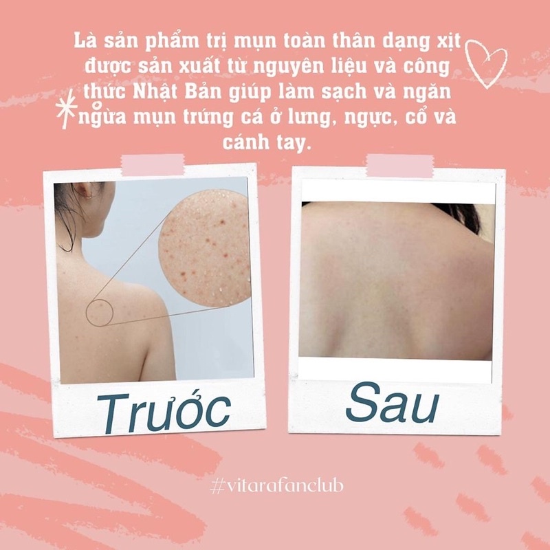Xịt Mụn Lưng, Ngực, Mông Vitara SE Body Acne Spray Giảm Mụn, Mờ Thâm, Sáng Da Thái Lan 50ML - Wincy Mart