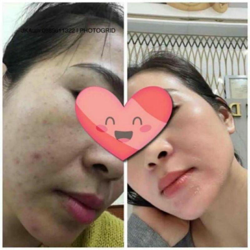 Kem nám Cosmelan2 - Chuyên về nám mảng ,nám chân sâu , đốm nâu , tàn nhang , đồi mồi , da không đều màu