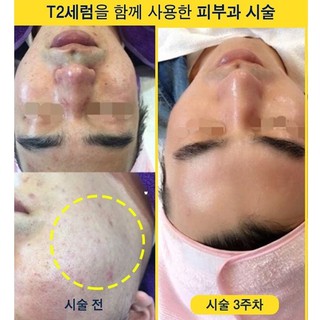 (Bill) Tinh Chất Vi Kim DR. TISHA T2 SERUM