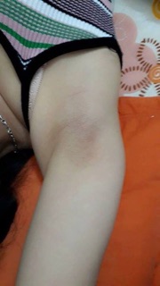 Combo triệt lông wax + mỡ trăn