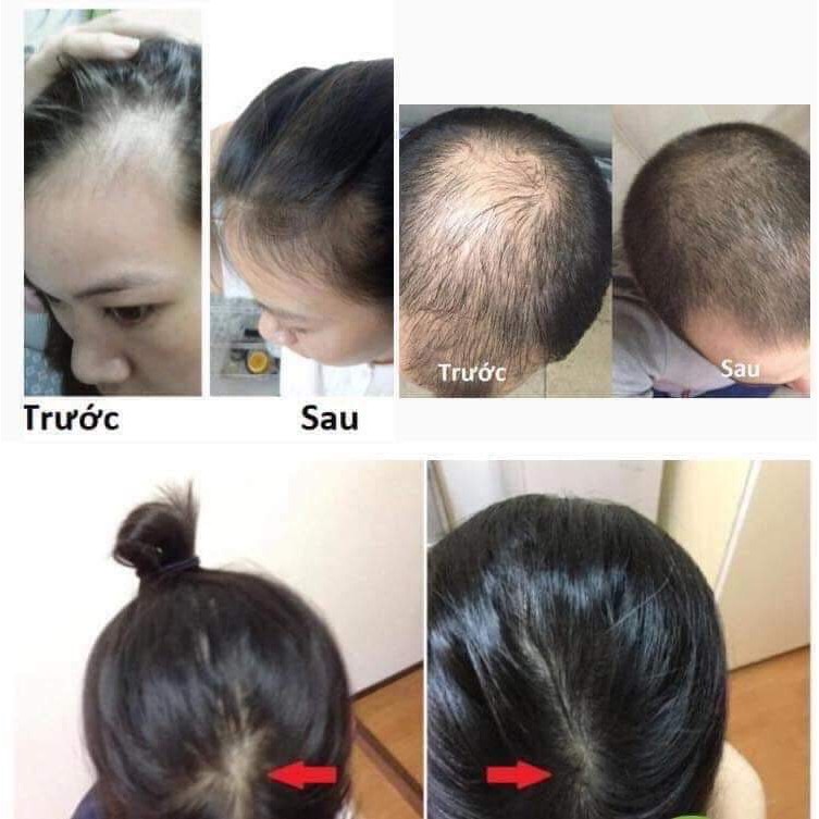 [CHÍNH HÃNG] Tinh Dầu Bưởi Kích Thích Mọc Tóc Vi Jully - Thoitrangtocnhuom | BigBuy360 - bigbuy360.vn