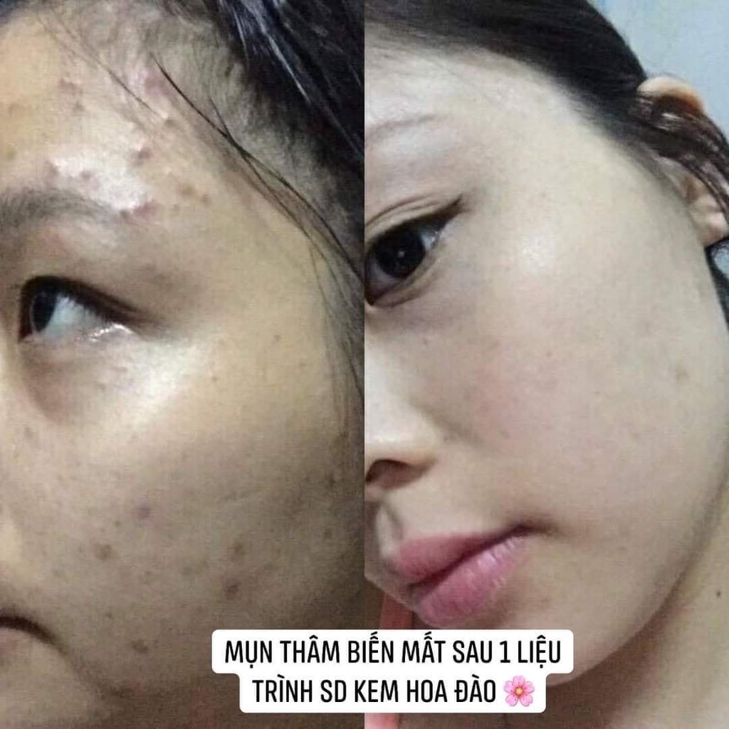 Kem mụn Hoa Đào thảo dược giảm mụn sau 2 tuần dưỡng trắng da mờ thâm mụn sẹo thu nhỏ lỗ chân lông
